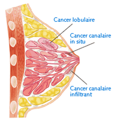 carcinome infiltrant du sein carcinome infiltrant du sein